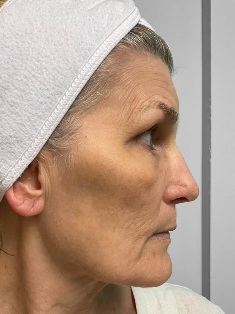After Image: Microneedling & Laser – Jade - right-side