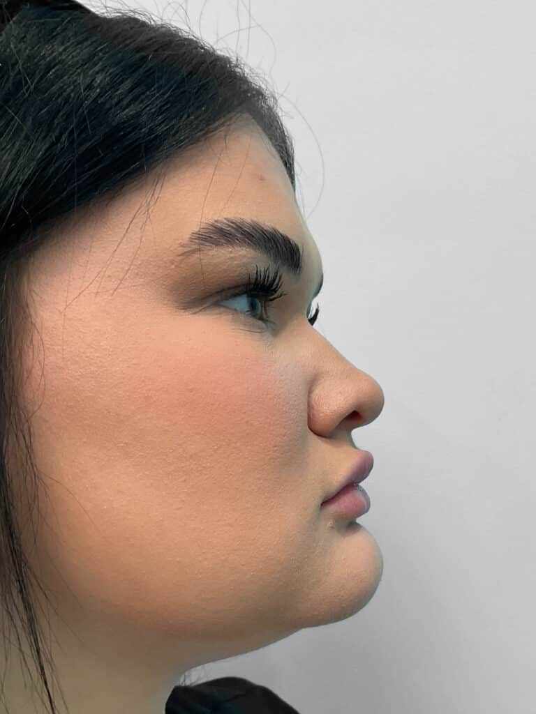 After Image: Lip Filler – Heather -