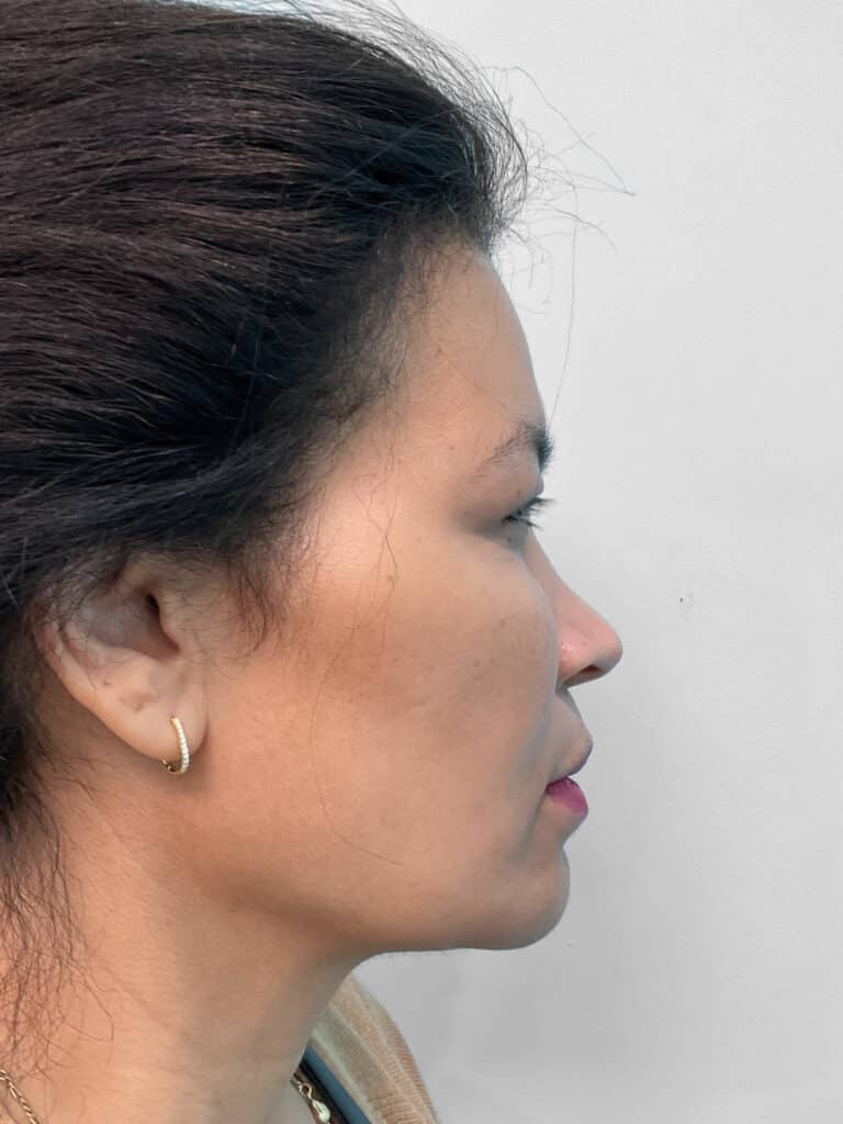 After Image: Injectables – Heather - right-side