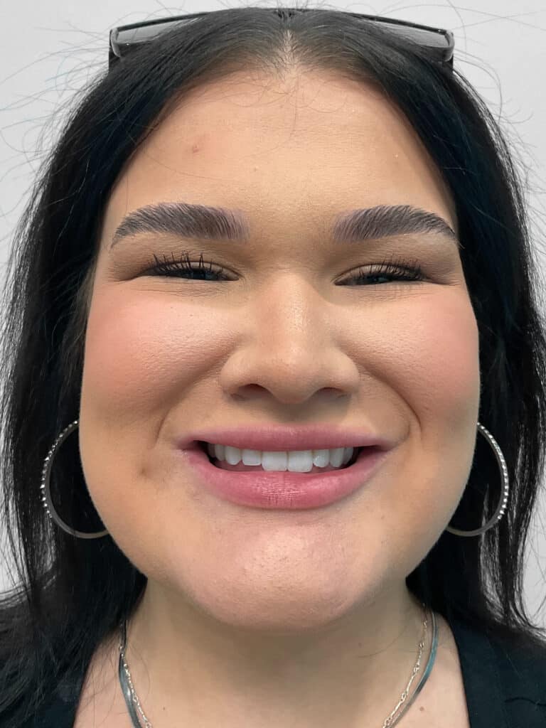 After Image: Lip Filler – Heather - front