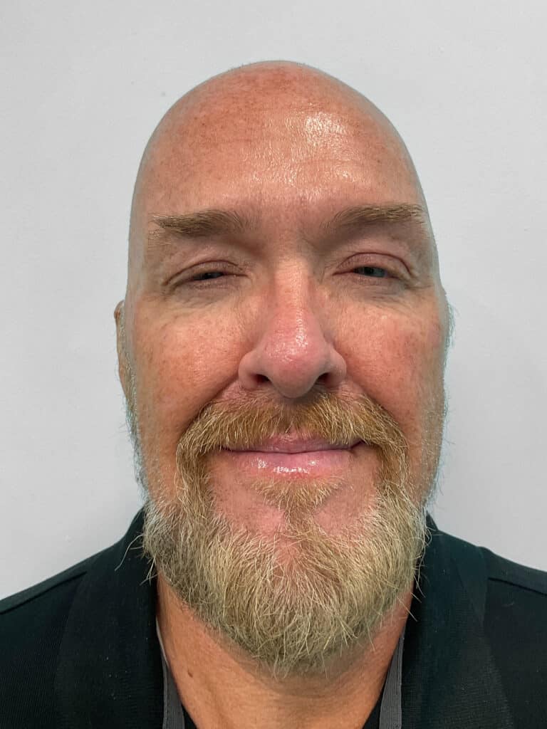 After Image: Botox – Heather - front