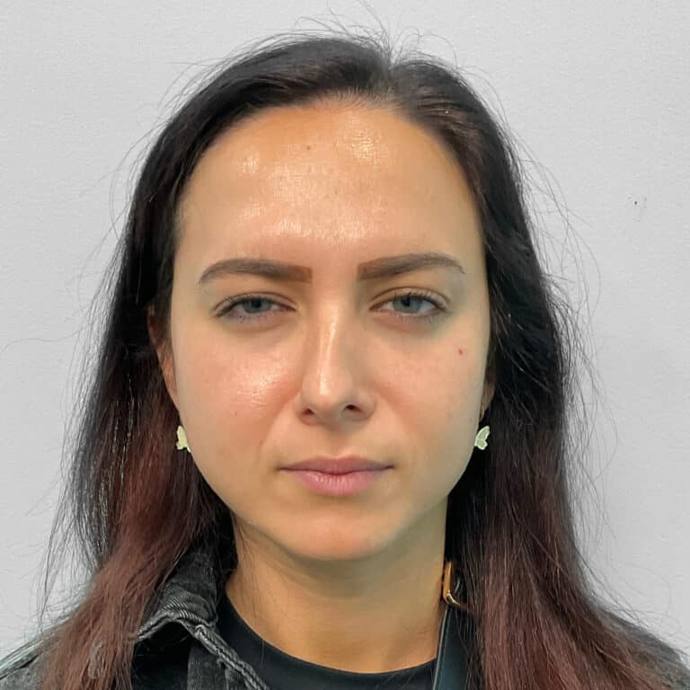 After Image: Botox – Joy - front