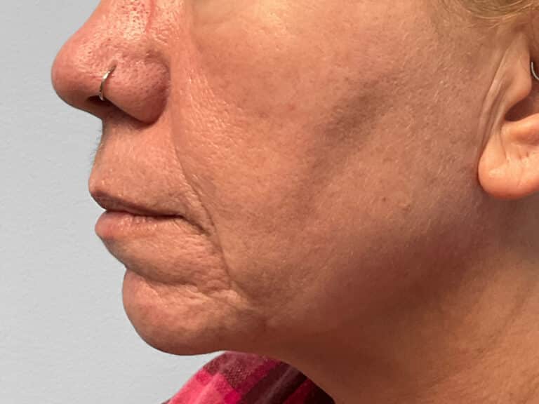 Before Image: Microneedling & Laser – Jade - left-side