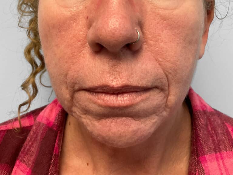 Before Image: Microneedling & Laser – Jade - front