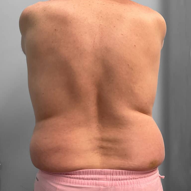 Before Image: Emsculpt – Jessica - back
