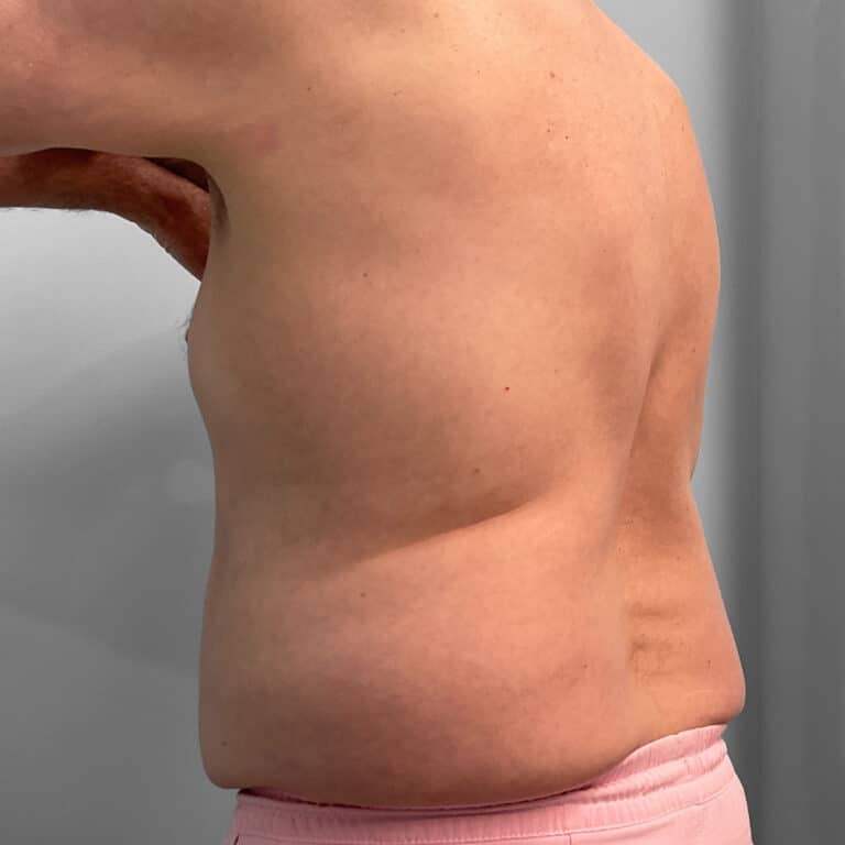 Before Image: Emsculpt – Jessica - left-back-oblique