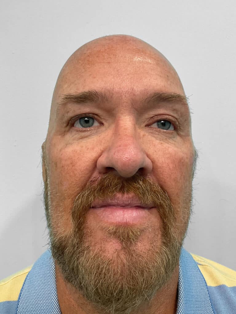 Before Image: Botox – Heather - front