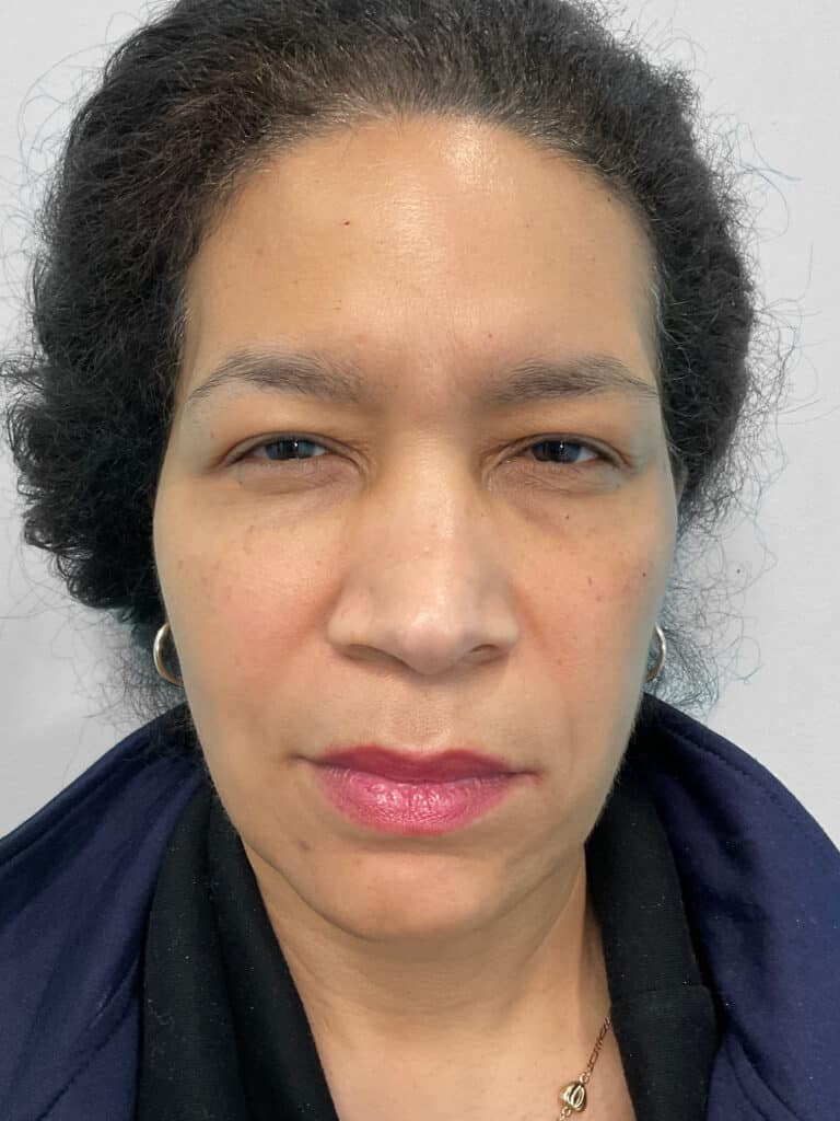Before Image: Injectables – Heather - front
