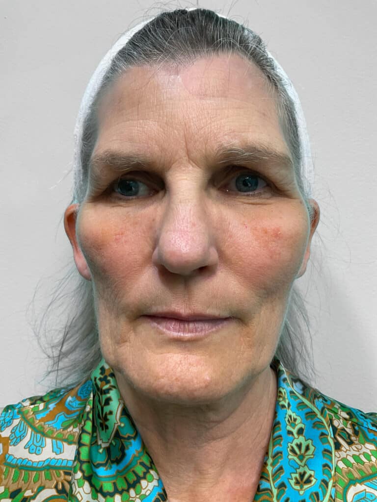 Before Image: Microneedling & Laser – Jade - front