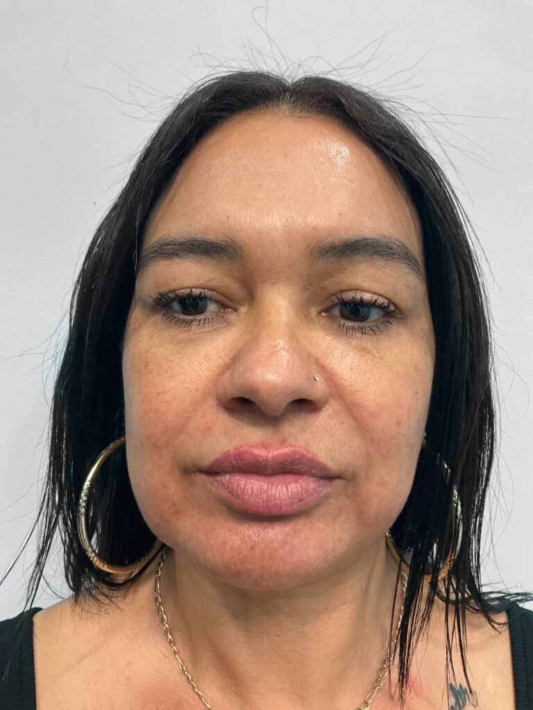 Before Image: Restylane Kysse – Heather - front