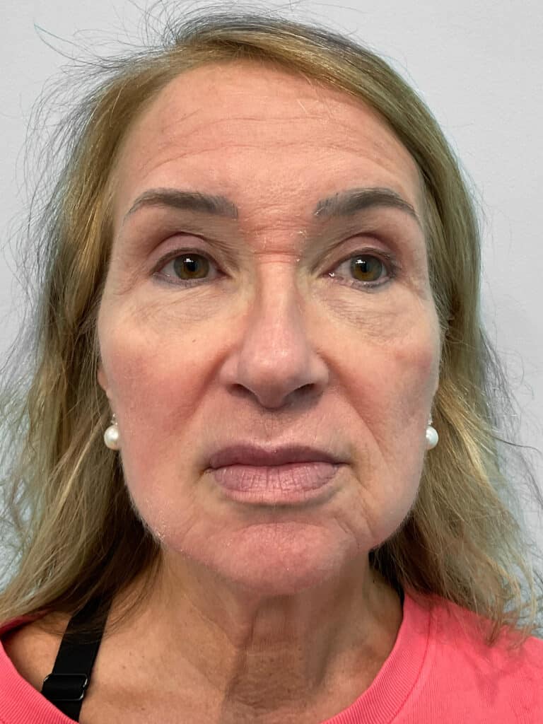 Before Image: Lip Flip – Heather - front