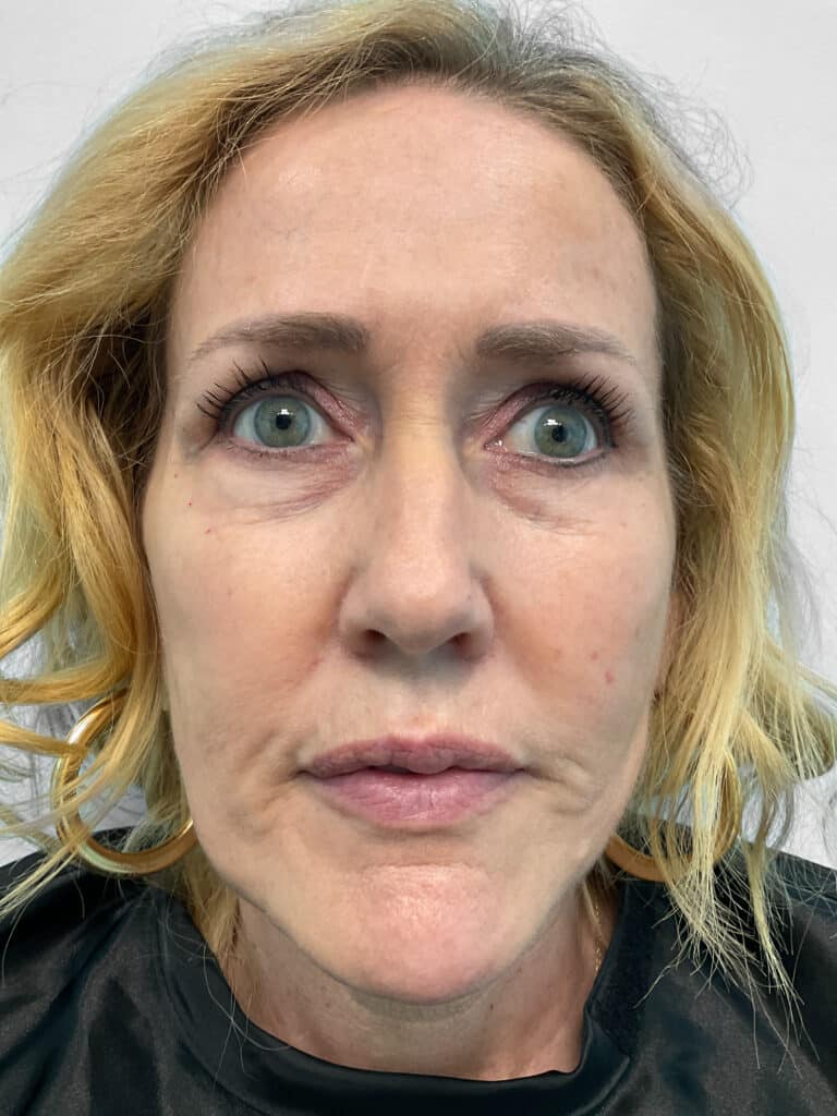 Before Image: Filler – Heather - front