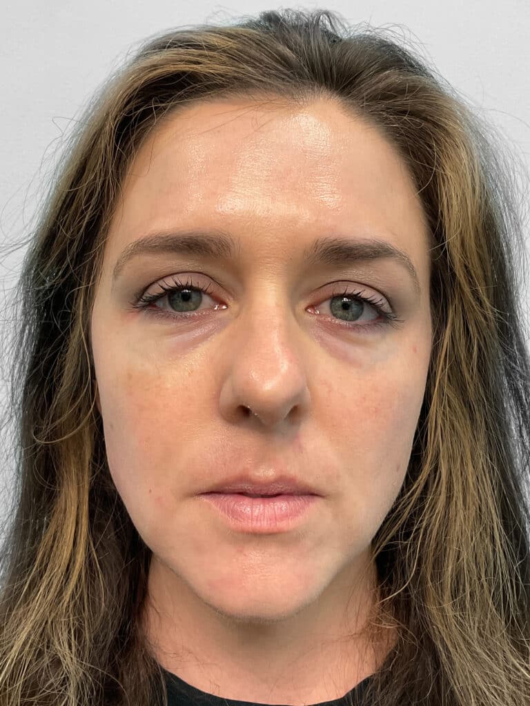 Before Image: Filler – Heather - front