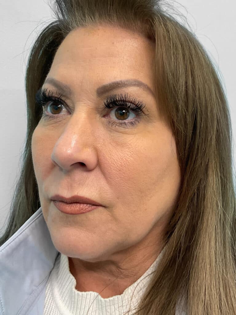 Before Image: Restylane Kysse – Heather - left-front-oblique
