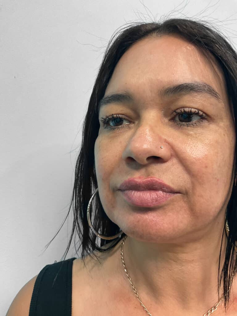 Before Image: Restylane Kysse – Heather - left-front-oblique