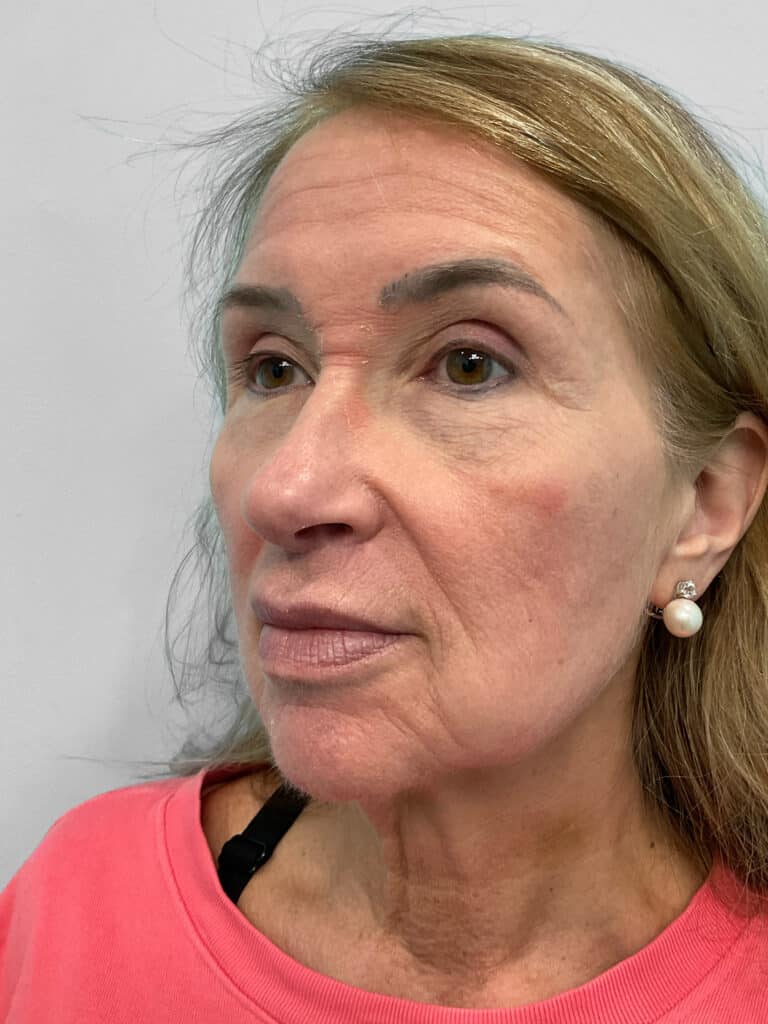 Before Image: Lip Flip – Heather - left-front-oblique