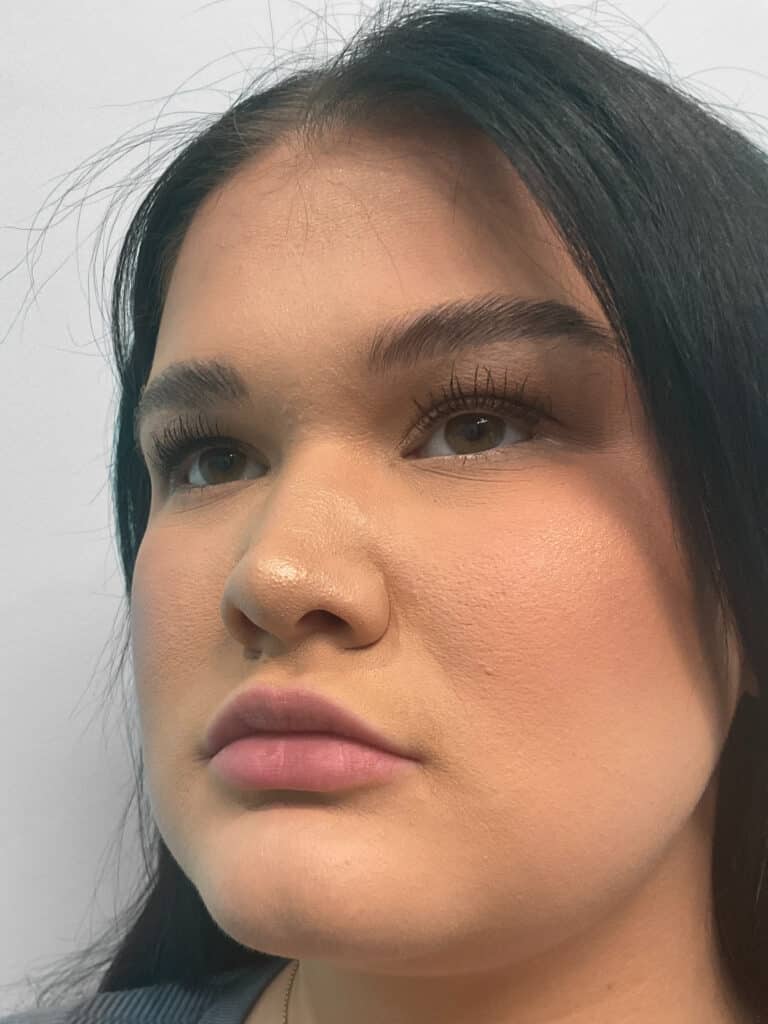 Before Image: Lip Filler – Heather - left-front-oblique