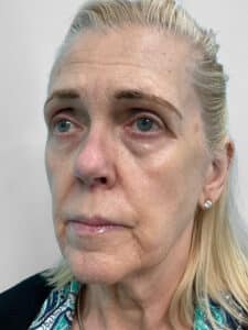 Before Image: Injectables- Heather