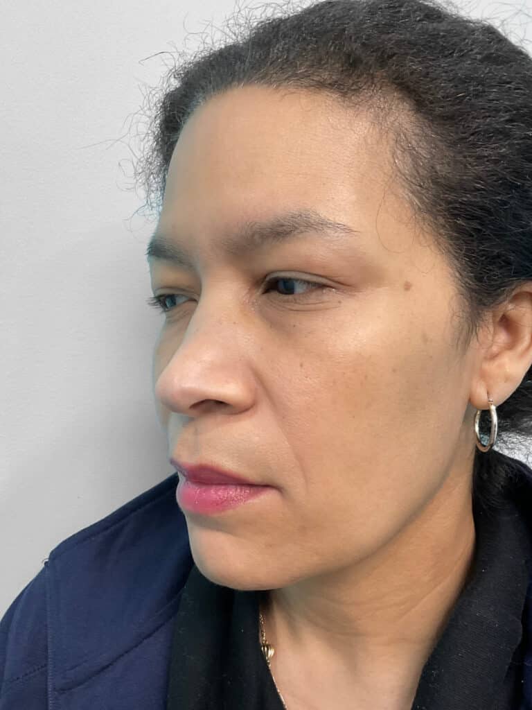 Before Image: Injectables – Heather - left-front-oblique