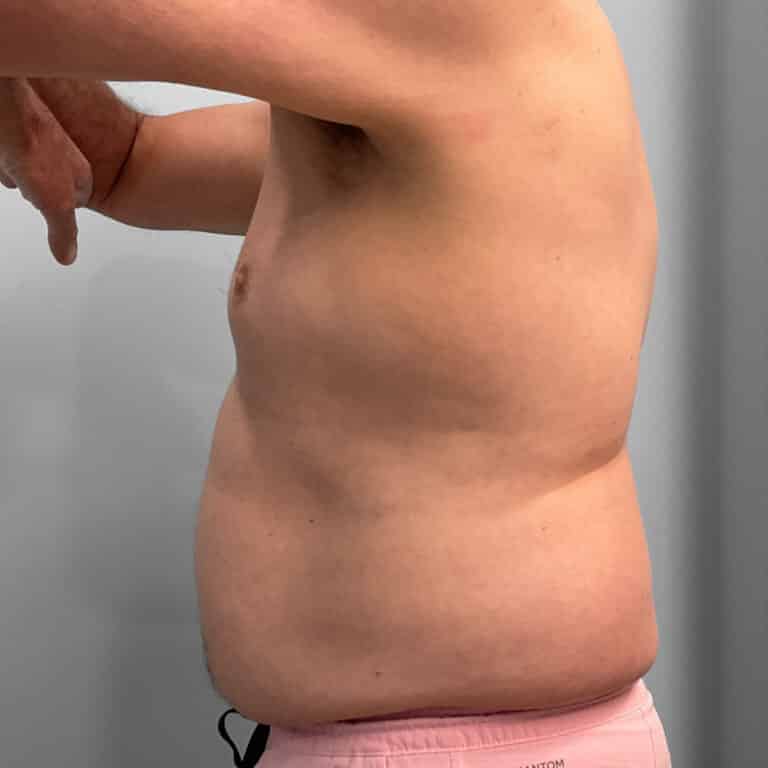 Before Image: Emsculpt – Jessica - left-side