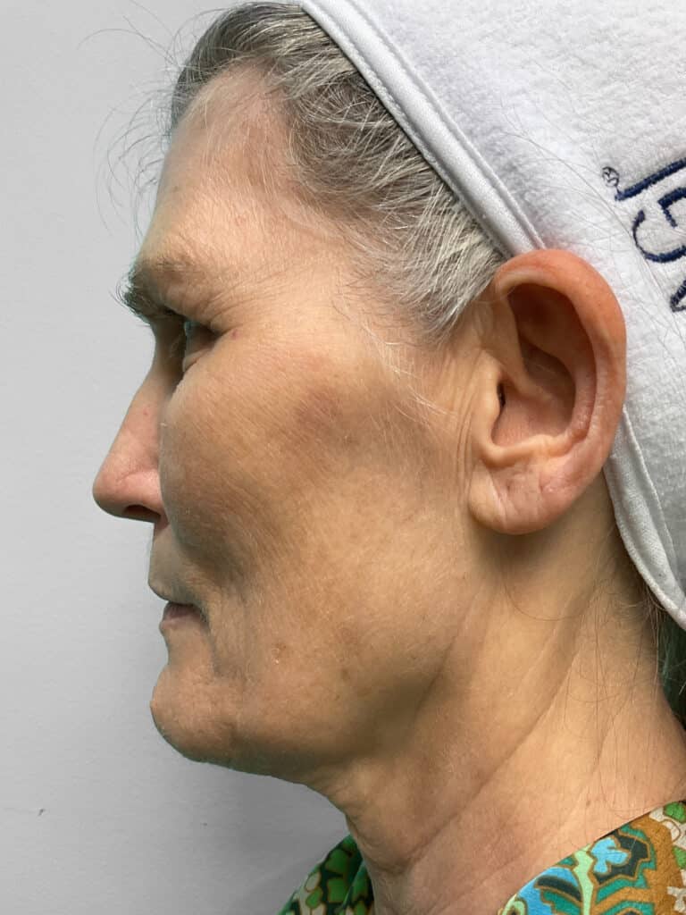 Before Image: Microneedling & Laser – Jade - left-side