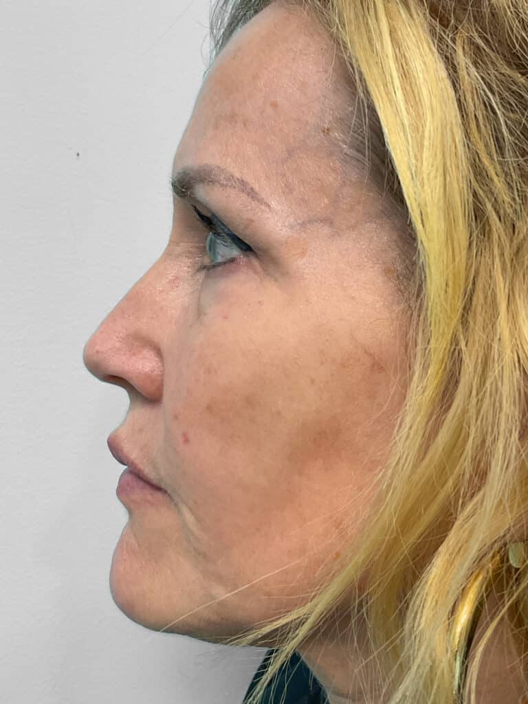 Before Image: Filler – Heather - left-side