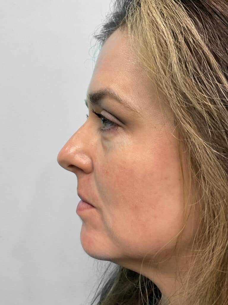Before Image: Filler – Heather - left-side