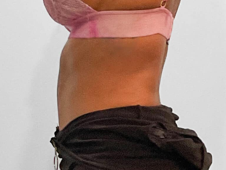 Before Image: Emsculpt Neo – Jessica - left-side