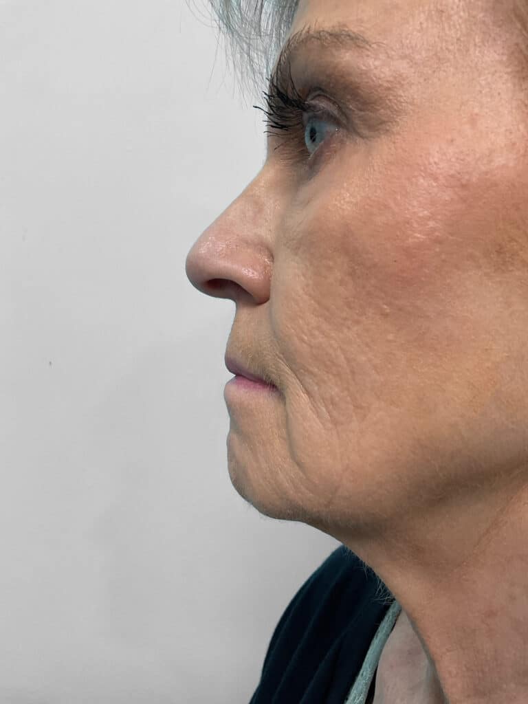 Before Image: Filler – Heather - left-side