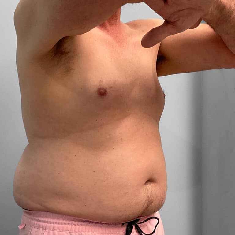 Before Image: Emsculpt – Jessica - right-front-oblique