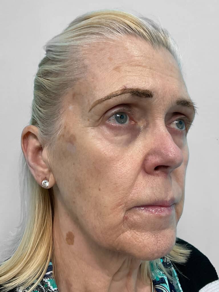 Before Image: Injectables- Heather - right-front-oblique
