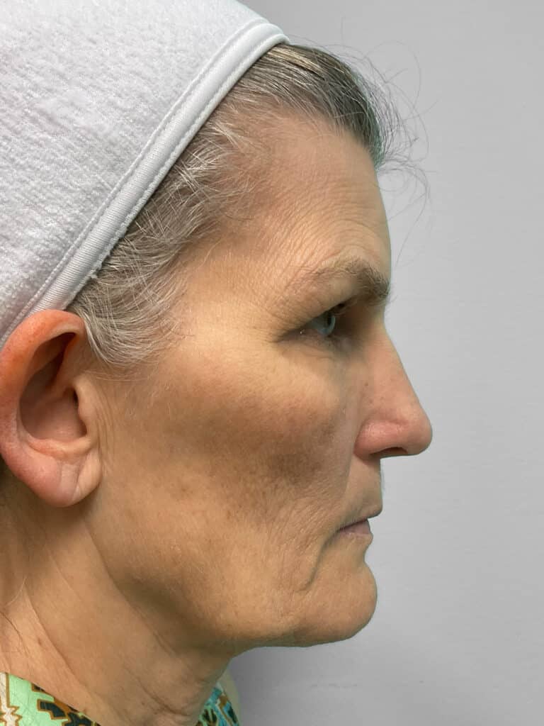 Before Image: Microneedling & Laser – Jade - right-side