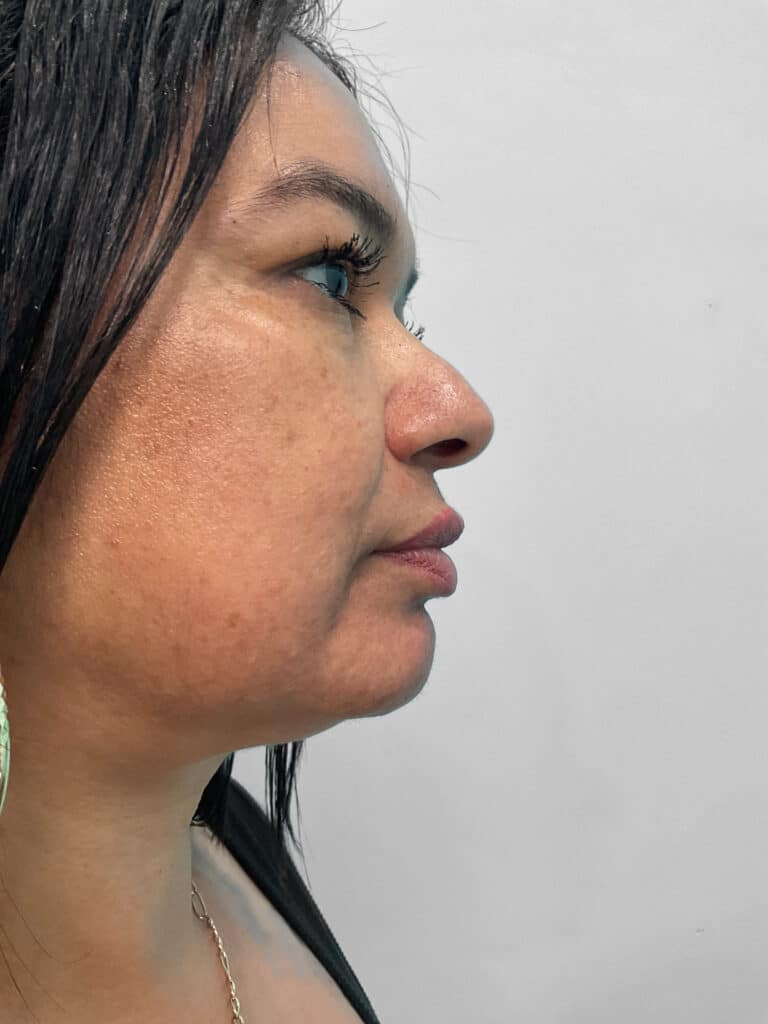 Before Image: Restylane Kysse – Heather - right-side