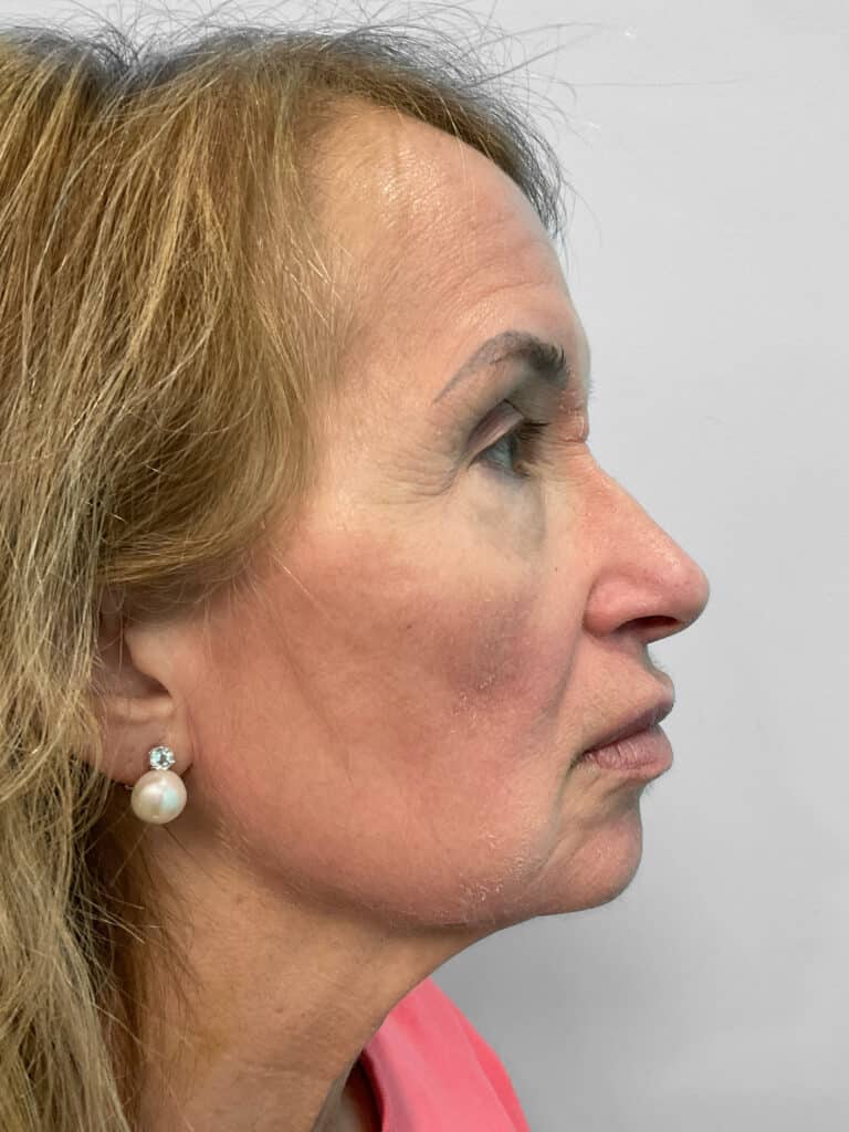Before Image: Lip Flip – Heather - right-side