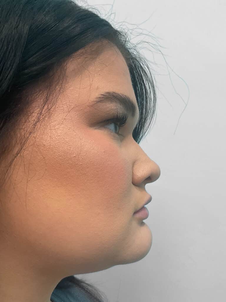 Before Image: Lip Filler – Heather -