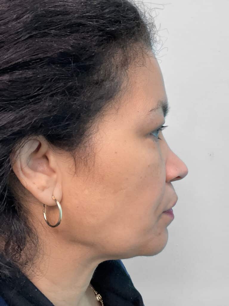 Before Image: Injectables – Heather - right-side