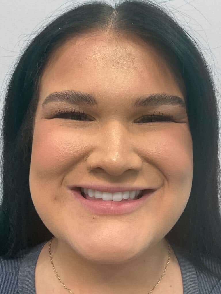 Before Image: Lip Filler – Heather - front