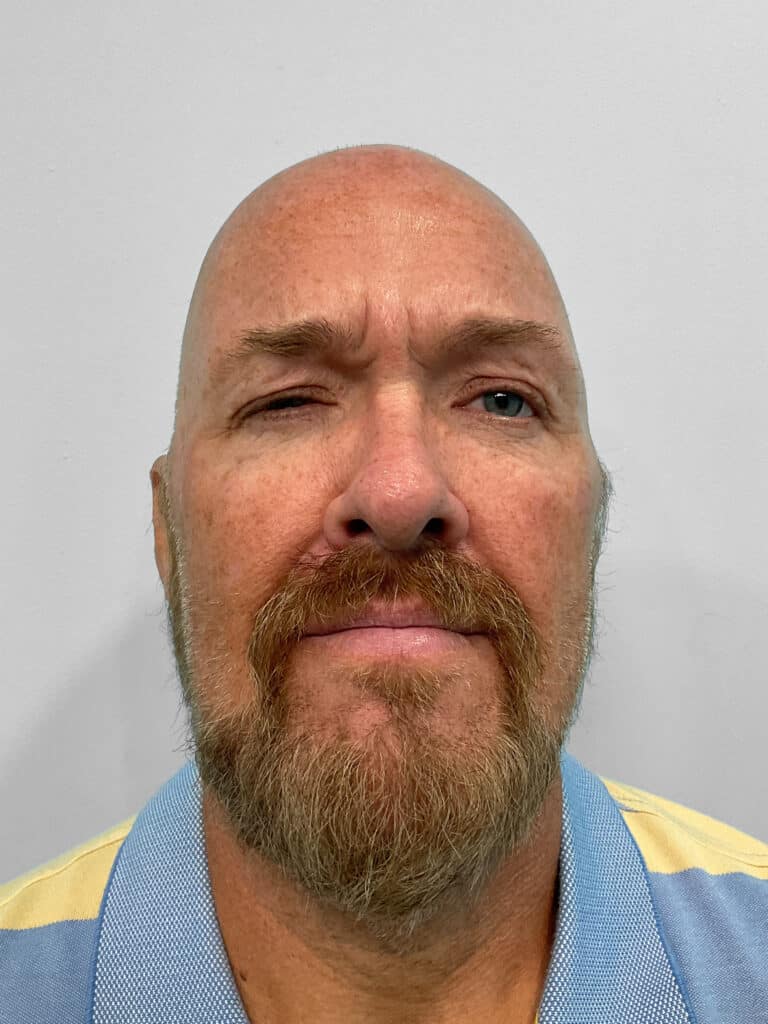 Before Image: Botox – Heather - front