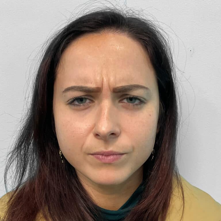 Before Image: Botox – Joy - front
