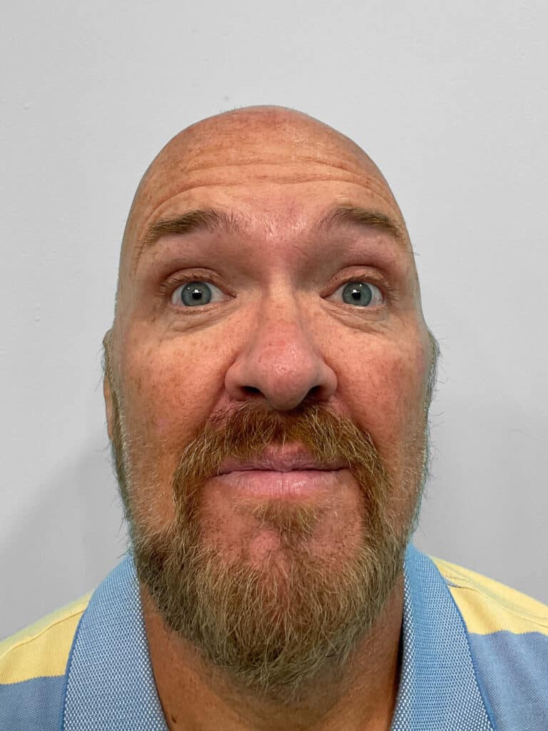 Before Image: Botox – Heather - front