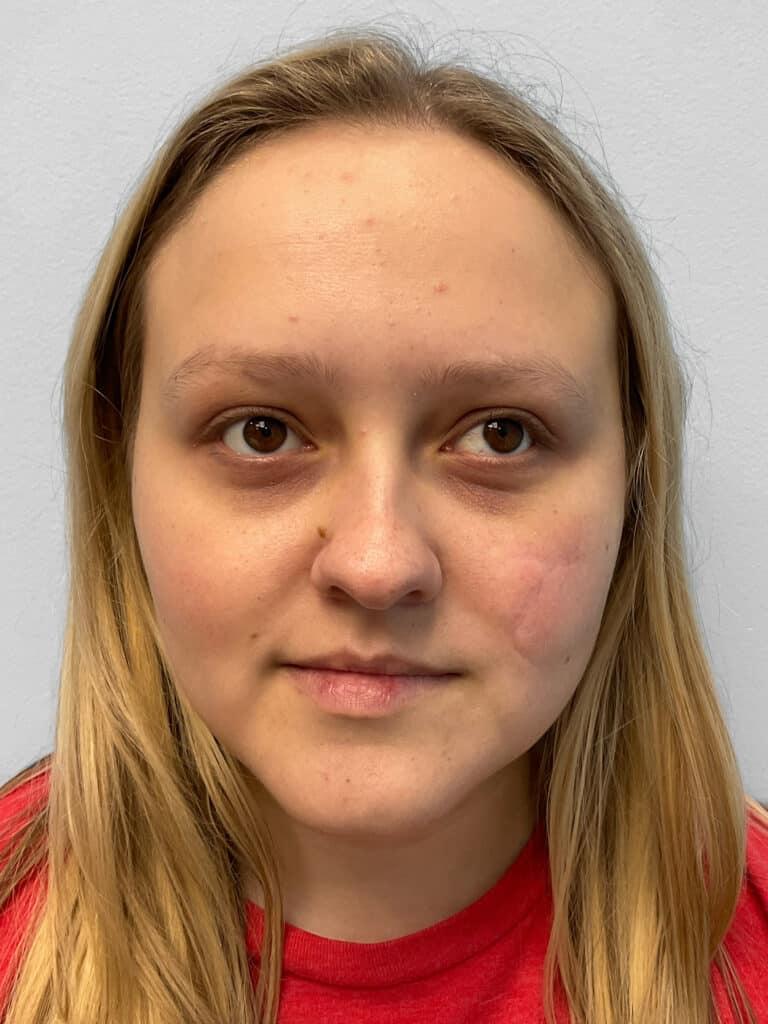 After Image: Microneedling- Kayla - front