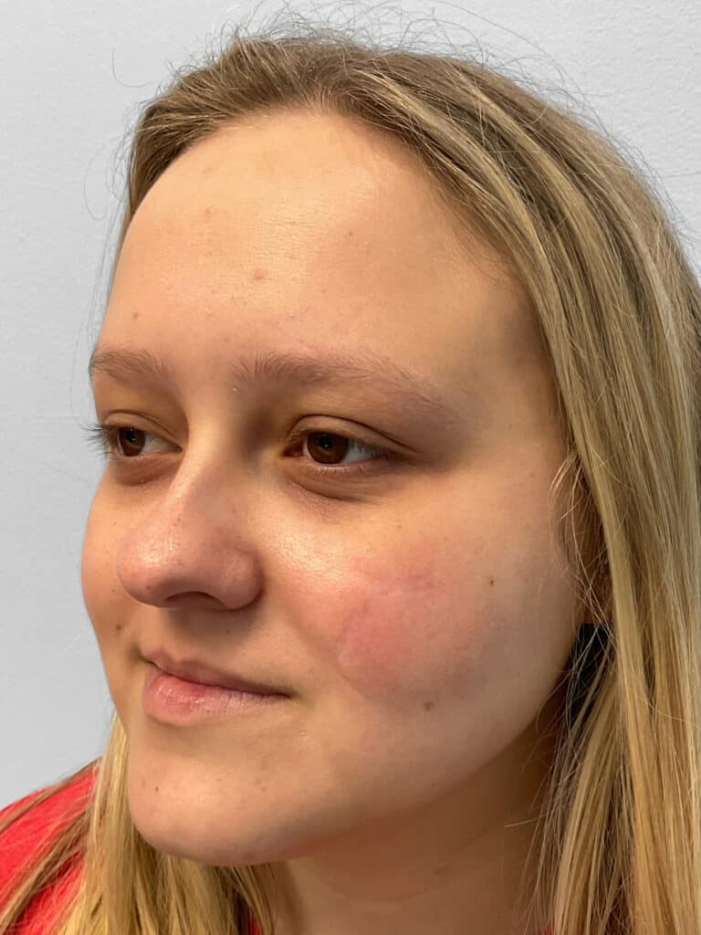 After Image: Microneedling- Kayla - left-front-oblique