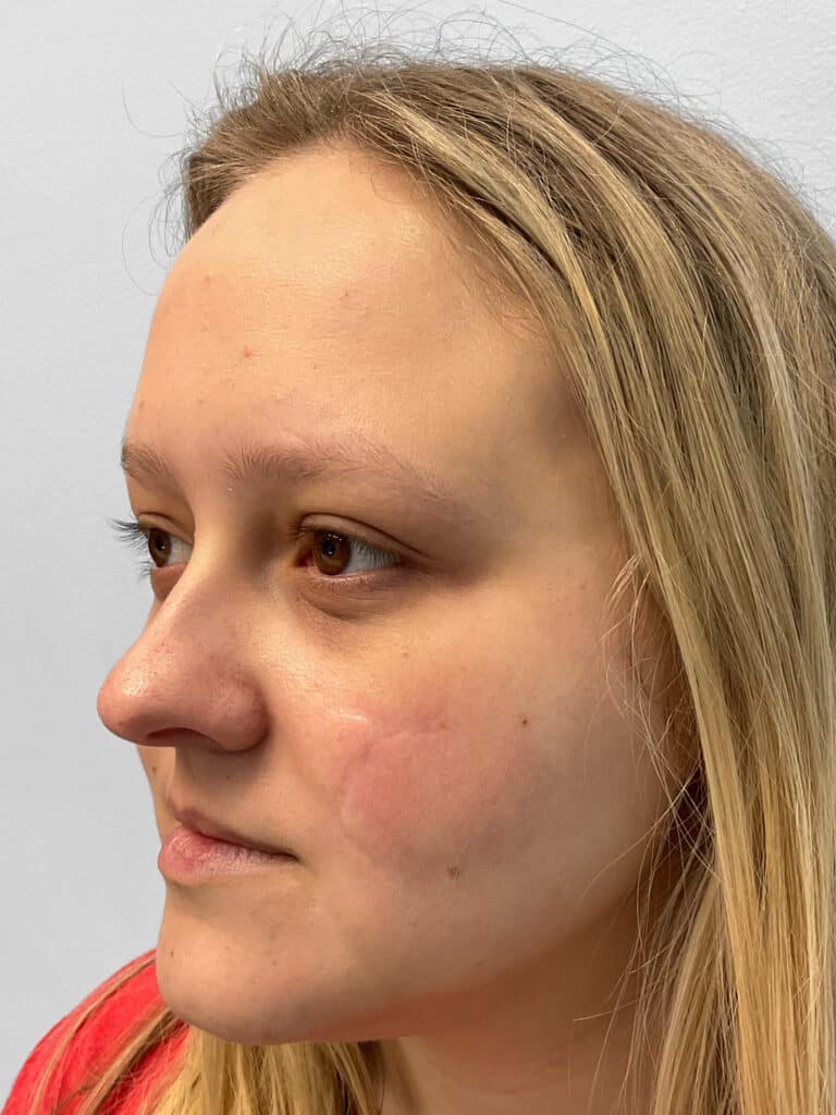 After Image: Microneedling- Kayla - left-side