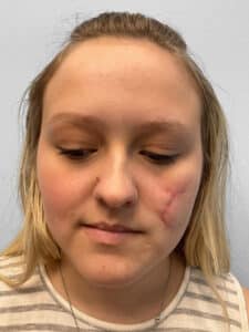 Before Image: Microneedling- Kayla