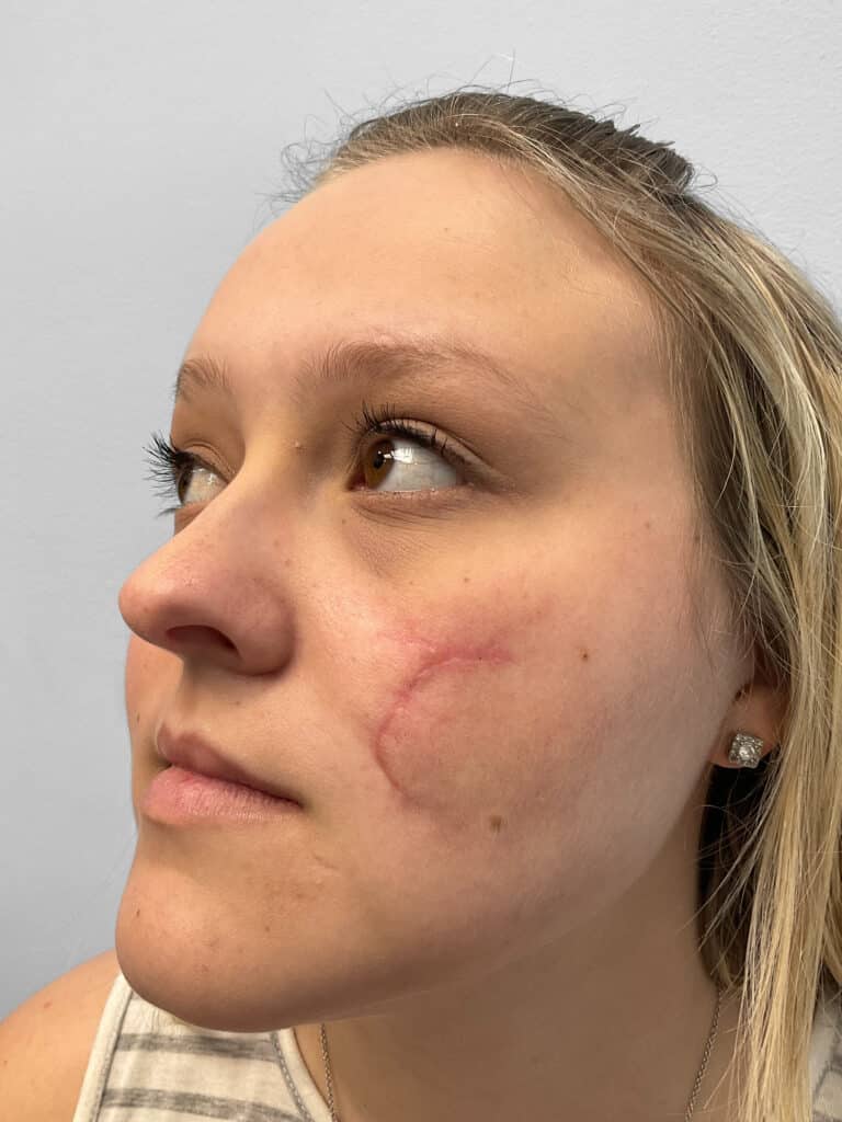 Before Image: Microneedling- Kayla - left-front-oblique