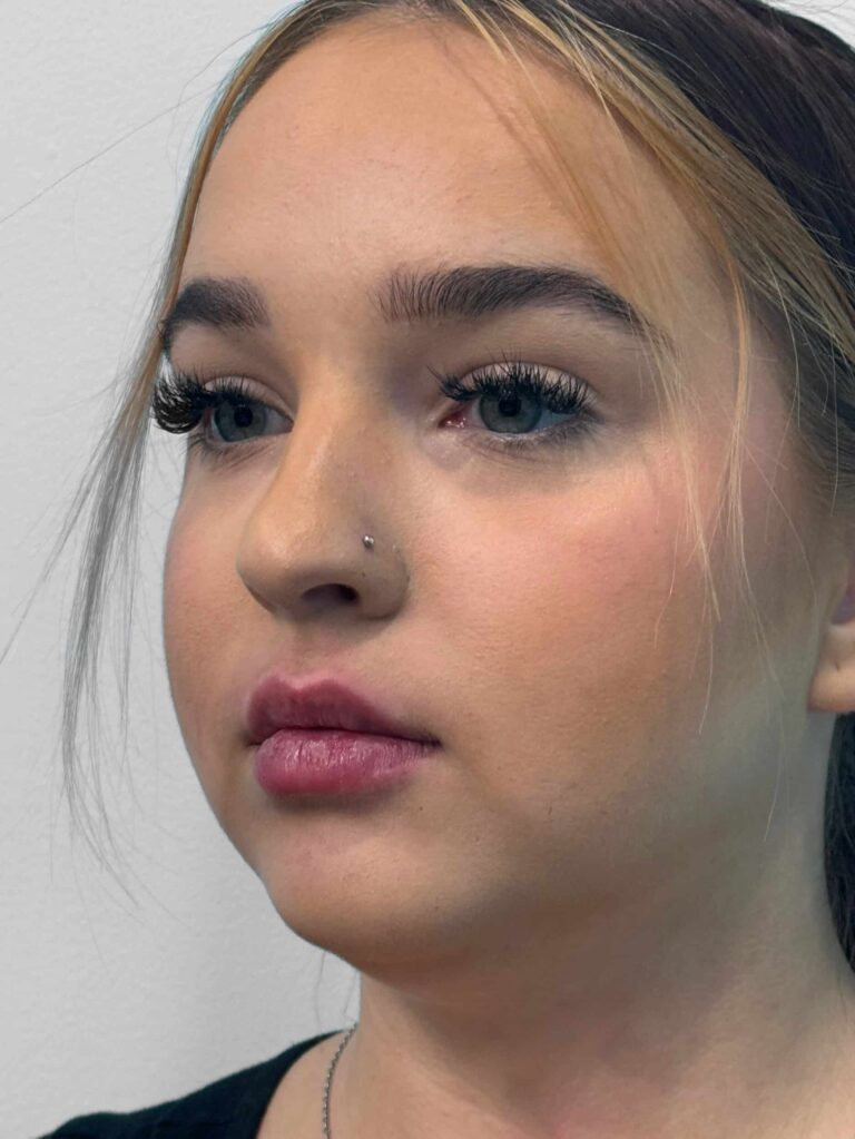 After Image: Juvederm – Joy - left-front-oblique