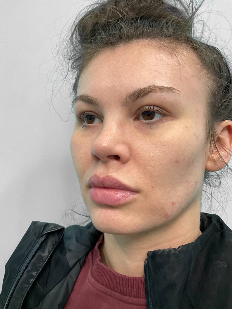 After Image: Juvederm – Heather - left-front-oblique