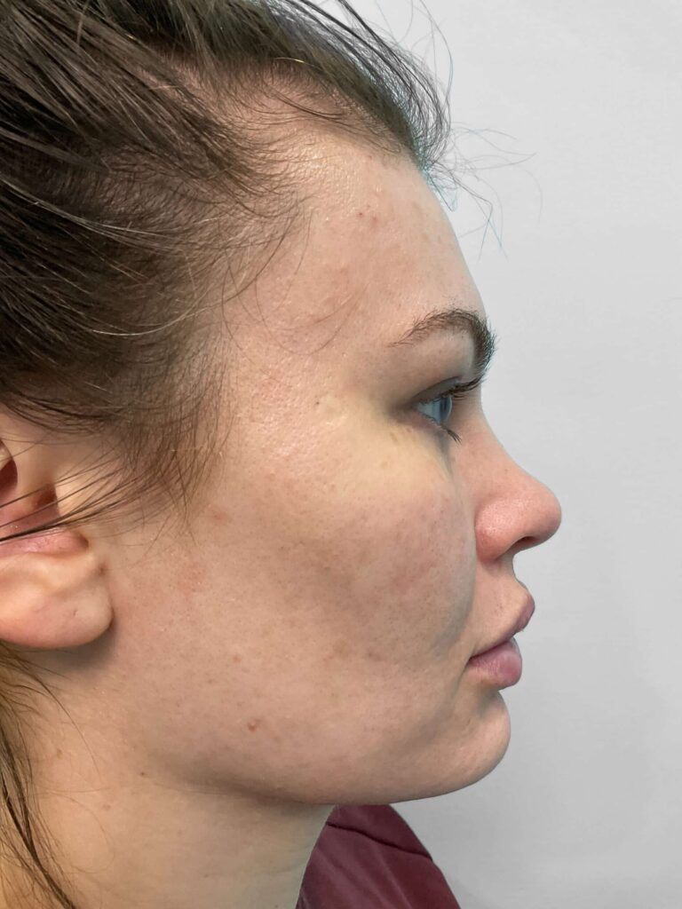 After Image: Juvederm – Heather - right-side