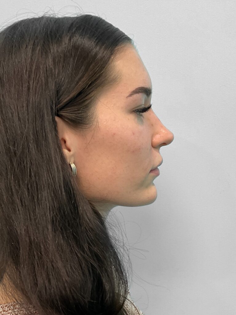 After Image: Juvederm – Joy - front