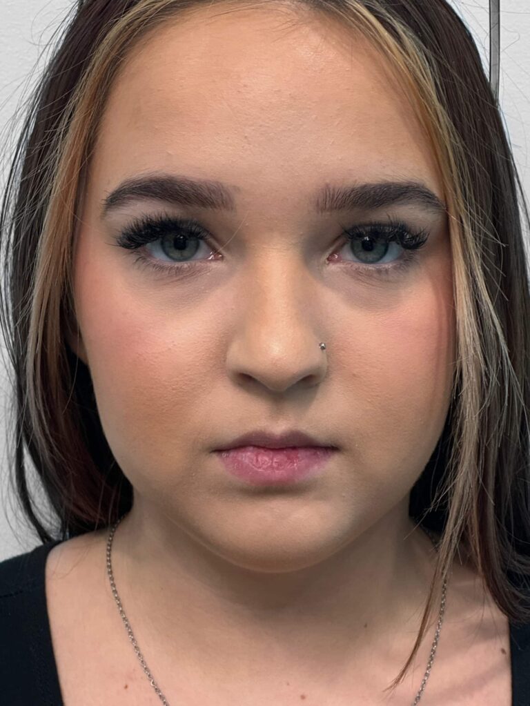 Before Image: Juvederm – Joy - front